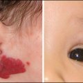 Cẩn trọng với bướu máu