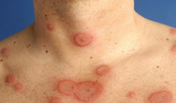 Các ban đỏ bất thường trên da là dấu hiệu nhận biết bệnh Lupus ban đỏ lupus ban đỏ có di truyền không 1