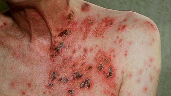 thời gian chuyển từ hiv sang aids là bao lâu 2